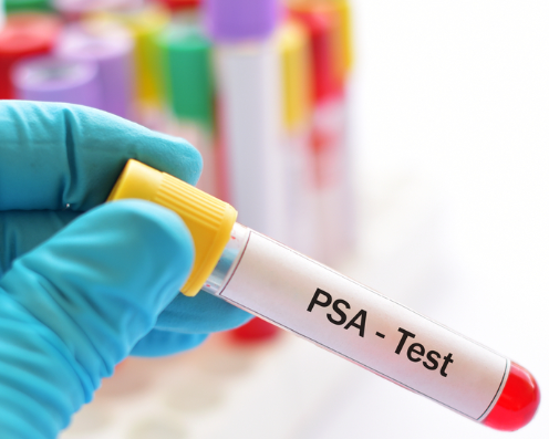 PSA, to screen or not to screen?